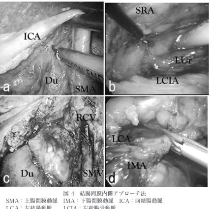 図 5　ラッププロテクター TM の装着 a：上行結腸と回腸をループ状に脱転する． b：自動縫合器を用いた機能的端々吻合．図 4　結腸間膜内側アプローチ法 SMA：上腸間膜動脈　IMA：下腸間膜動脈　ICA：回結腸動脈LCA：左結腸動脈 LCIA：左総腸骨動脈SMV：上腸間膜静脈　RCV：右結腸静脈Du：十二指腸 LUr：左尿管a：右結腸内側アプローチ：回結腸血管を腹側に挙上．b：左結腸内側アプローチ：上直腸動脈を腹側に挙上． いずれの場合も，鉗子を背面のスペースに深くすべりこませることで，術野展開が良好に