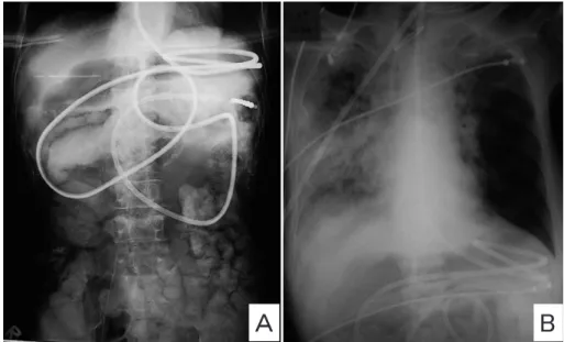 Fig.  1  A: An abdominal X-ray ﬁlm obtained after a Gastrographin infusion through an ileus tube. 