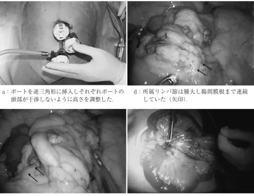 図  2 手術所見a： ポートを逆三角形に挿入しそれぞれポートの頭部が干渉しないように高さを調整した．b： 病変部はトライツ靭帯から約 50 cm の上部空腸に認め腫瘍は漿膜に露出していた（矢印）．c： 大網の表面には 2 cm 大の白色の結節性病変がみられ腹膜播種と診断した（矢印）． d： 所属リンパ節は腫大し腸間膜根まで連続していた（矢印）． e： 臍部の創を開腹しウンドリトラクターを装着 しリンパ節郭清を伴う小腸部分切除を行った． 図  3 切除標本および病理組織学的所見a： 大きさは径 4×3 cm
