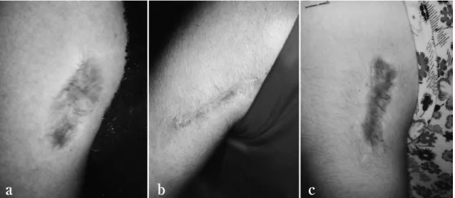 Fig.  1　The keloid was located in the upper arm.