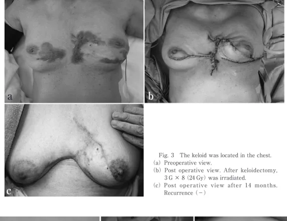 Fig.  3　The keloid was located in the chest.
