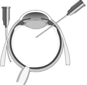 図 5　トリアムシノロン施行前後の光干渉断層撮影（Optical Coherence Tomography：OCT）による黄斑浮腫の評価 OCT 上，施行前の網膜には浮腫を認め，網膜厚は 420 μm，視力 0.2 であった（上図）．トリアムシノロン 12 mg テノ ン嚢下注入を施行したところ，浮腫は軽減し，網膜厚 230 μm，視力は 0.8 に改善した（下図）．