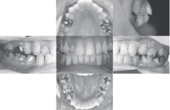 Fig. 6   Fixed appliance with power arms and elastics.
