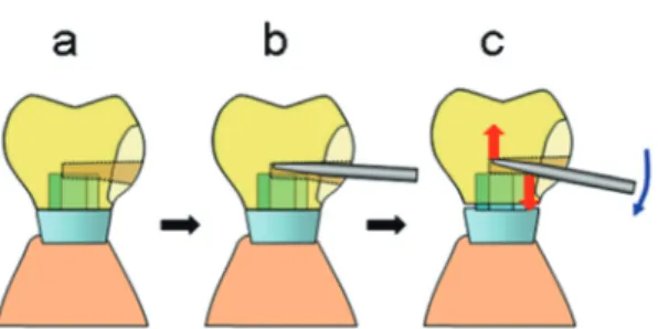 Fig. 2    Schematic illustration of: a: Cross section of superstructure and working  cast