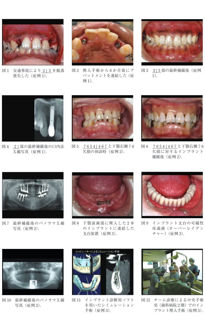 図 1   交通事故により 2 | 3  を脱落 喪失した（症例 1）． 図 2   埋入手術から 6 か月後にアバットメントを連結した（症 例 1）． 図 3   2 | 3 部の最終補綴後（症例1）． 図 4   2 | 部の最終補綴後の口内法 Ｘ線写真（症例 1）． 図 5   7 6 5 4 | 4 6 7 と下顎右側 7 6欠損の初診時（症例2）． 図 6   7 6 5 4 | 4 6 7 と下顎右側 7 6欠損に対するインプラント 補綴後（症例 2）． 図 7   最終補綴後のパノラマＸ線 写