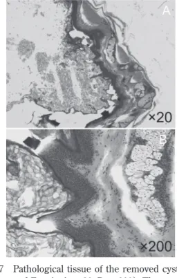 Table  1 Cases of large dermoid cyst and epidermoid cyst reported in Japan.