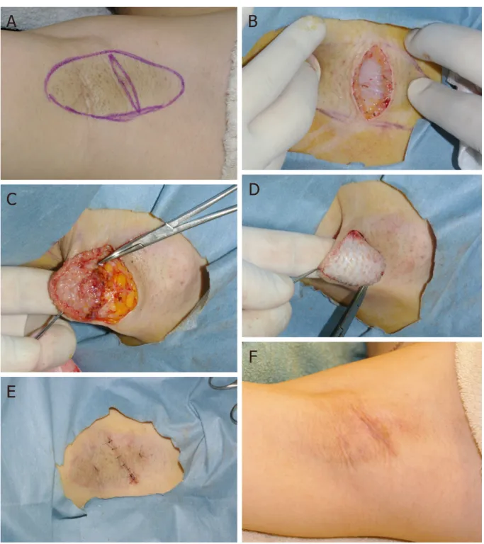 Figure 2. Open excision procedures: A: the incision plan according to Rigg [22] ; B: a small elliptical sliver of skin is removed, and the  apocrine glands lined above the fascia are seen; C: after the subdermal layer of the axilla is undermined, the apocr