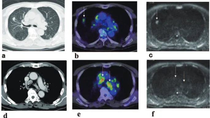 Fig. 2 Case 2.  ( a ‒ c )  Comparison of a primary lung cancer among non-contrast CT  ( a ) , FDG-PET/CT  ( b )  and DWI  ( c ) .  ( a )   The non-contrast CT showed a nodule of 20mm in the right upper lobe.  ( b )  FDG-PET/CT showed an FDG accumulation  (