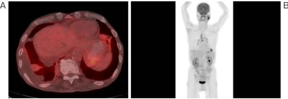 図 2 （A）ドレーン抜去後の PET-CT 所見．右 S9 結節への取り込み（SUVmax＝3.0）を認め る．（B）同 PET-CT．左耳下腺，縦隔リンパ節，肺野内の取り込みを認める．縦隔リンパ節  #7，#10R に取り込みを認める． A B C D 図 3 （A）右S9 結節のTBLB検体．リンパ球や形質細胞の高度浸潤を認める［hematoxylin-eosin（HE） 染色，×40］．（B）右 S9 結節の TBLB 検体．紡錘細胞が浸潤した間質に小リンパ球，形質細胞，一 部に組織球を交え浸潤して