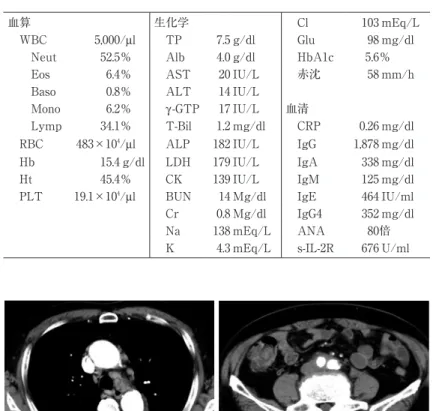 図 1 胸腹部造影CT所見．胸水貯留，胸膜肥厚，縦隔リンパ節腫脹を認める．ま た，腹部大動脈から総腸骨動脈周囲のシート状の軟部影を認める． 表 2 胸水検査所見 pH 7.4 T-chol 128 mg/dl 比重 1.023 TG 25 mg/dl 色 黄色 CEA 1.0 ng/ml WBC 3,800/μl ADA 56.7 U/L Neut 19％ IgG4 331 mg/dl Eos 3％ 培養 Lymp 78％ 一般細菌 陰性 TP 5.7 g/dl 抗酸菌 陰性 LDH 390 IU/L PC