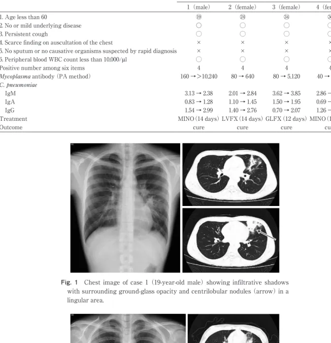Fig. 1 Chest image of case 1 （19-year-old male） showing infiltrative shadows  with surrounding ground-glass opacity and centrilobular nodules （arrow） in a  lingular area