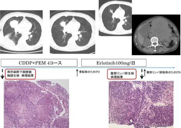 Fig. 4 Clinical course of this patient until transformation to small cell carcinoma.