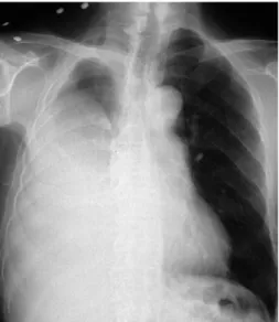 図 2 （a）胸部 PET-CT．肥厚した胸膜の一部に SUV の集積が認められた．（b）a の矢印の部位をねら い，CT ガイド下生検を施行した． a b 図 3 （a）CT ガイド下生検で得られた検体［hematoxylin-eosin（HE）染色，弱拡大］．矢印は臓側胸 膜表面で，zonation や胸膜面に垂直で細長い毛細血管はみられない．（b）CT ガイド下生検で得られ た検体（HE 染色，強拡大）．紡錘形の腫瘍細胞は密度が低く，膠原線維の増殖が著明で花むしろ様構 造がみられる． 図1 入院時の胸
