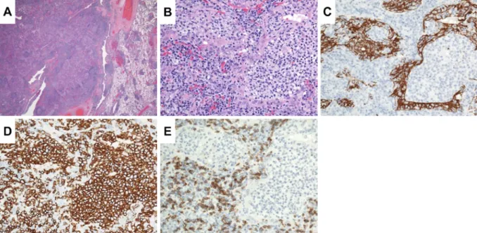 図 3  PET-CT 写真．胸腺に FDG の中等度集積を認め た（SUVmax＝3.56）．