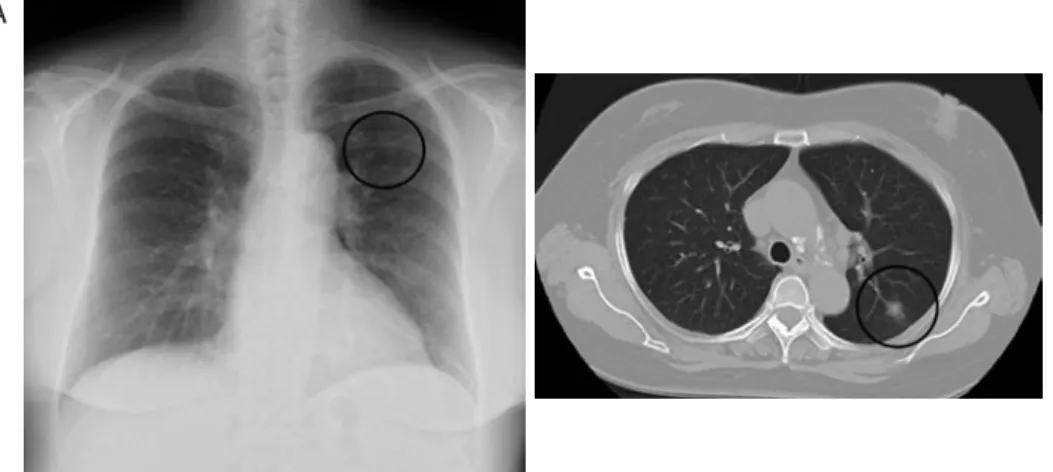 Fig. 2 Enhanced  thoracic  CT  shows  an  enhanced  anomalous vein draining into the left brachiocephalic  vein.