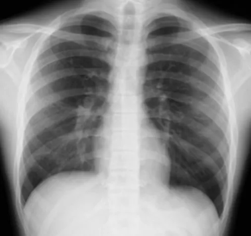 Fig. 4 Chest CT on the third hospital day shows centrilobular small nodules and bilateral  bronchial wall thickness.