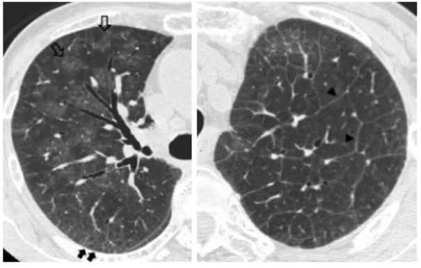 Fig. 2 Chest high-resolution computed tomography on  admission  showed  diffuse  ground-glass  opacities 