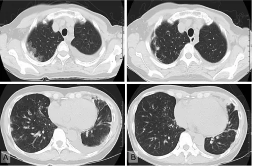 Fig. 3 Histopathological  findings  of  the  tumor  ob- ob- tained by lung autopsy showed a thrombotic embo-lism of tumor cells and an intimal proliferation in the  small pulmonary artery.