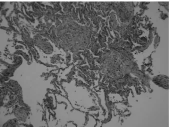 Fig. 4 Chest  CT  after  stopped  taking  health  food  showed almost complete resolution of the abnormal  shadows seen on admission