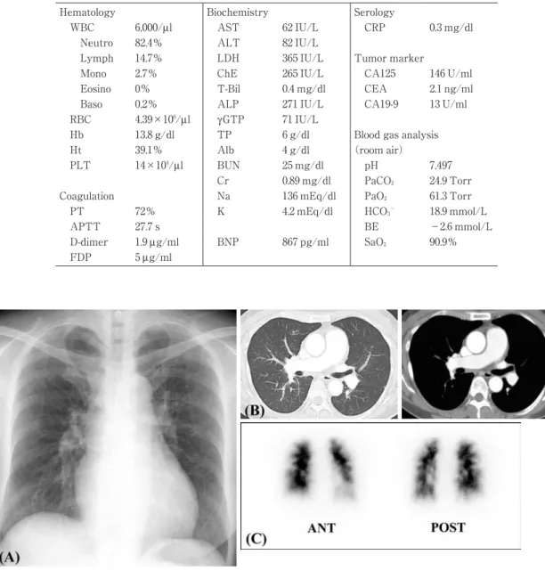 Fig. 1 Chest X-ray, chest enhanced CT scan, and  99 m Tc-MAA lung perfusion image on admission. （A, B） There are  no abnormal findings other than pulmonary artery enlargement. （C） The  99 m Tc-MAA lung perfusion images show  multiple peripheral defects.
