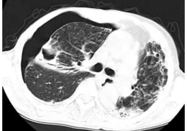 Fig.  2 Chest  computed  tomography  on  admission,  showing right pneumothorax with a small amount of   pleural effusion and consolidation with cavity forma-tion,  bronchioectasis  and  small  nodular  opacities  in  the right lung.