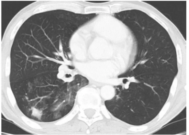 Fig.  2 Computed  tomography （CT）  on  admission  showed  a  solitary  lesion （19×20 mm） in  the  right  lower lobe.
