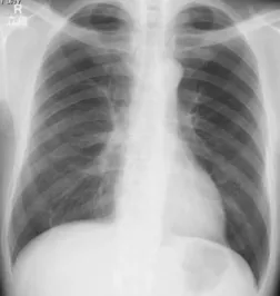 Fig.  6 Chest  X-ray  film  revealed  completely  cleared findings after six months.