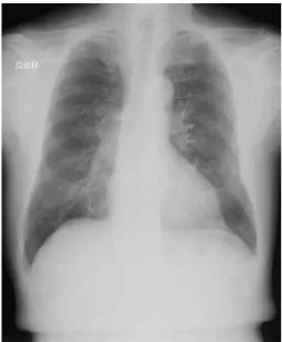 Fig.  1 A  chest  X-ray  film  on  admission  shows  nodular shadows in the left lower lung fields.