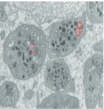 Fig.  3 Microscopic findings of usual interstitial pneu- 3 Microscopic findings of usual interstitial pneu-monia （UIP）.  Histologically  there  was  pleura-based  fibrosis  associated  with  muscle  tissue  proliferation,  structural  remodeling,  and  mic
