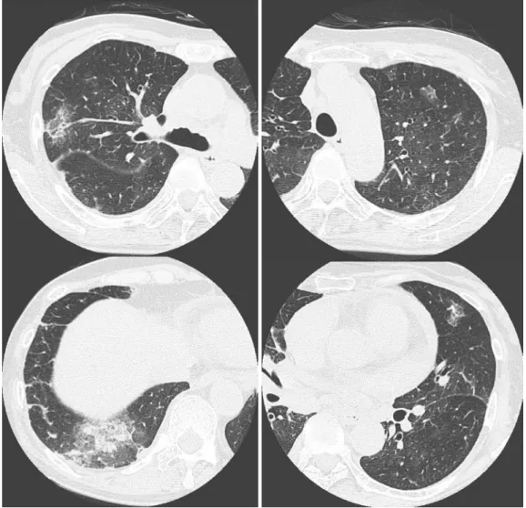 Fig.  3 Chest  CT  scan  on  admission  showing  ground-glass  opacity  and  patchy  shadows  in  both  lung  fields.