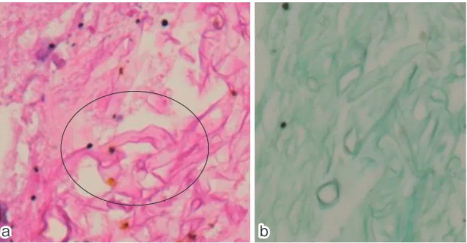 Fig. 5. Histological findings of the lung specimen (a) HE staining