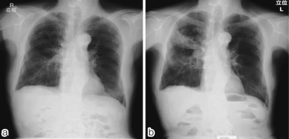 Fig. 7. Chest X-ray images (a) September X-1 year (b) September X year a