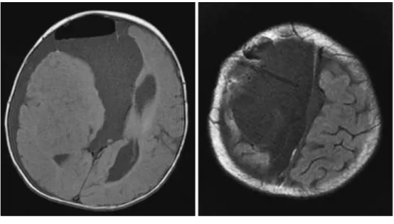 Fig. 2. 頭部 MRI（某月 6 日：T1 強調画像） 頭頂骨小開頭・嚢胞被膜切除術施行後 5 日。開放されたクモ膜下腔に髄液リザバーカテーテルが 挿入されているが，髄液腔の拡大が進行している。 肺野に異常陰影なし，頭部単純 CT；髄液腔拡大に変化 なし，その他著変なし。 症 例 の Problem List：＃生 後 4 カ 月 児，＃脳 脊 髄 液 シャント術後 6 日での発熱，＃炎症反応高値，＃特異的 な診察所見・検査所見なし。 これらの所見から，手術部位感染症が鑑別診断の筆頭 に挙がるが，診断