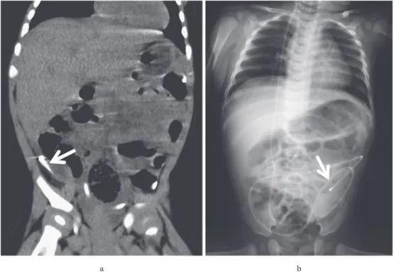 Fig. 3. 腹部画像検査  a）腹部単純 CT：シャントチューブ先端付近に嚢胞を認めず，腹膜炎を示唆する所見もみられない。 b）腹部単純レントゲン：前日の CT と比較しシャントチューブ先端の位置が移動しており，シャ ントチューブ先端の癒着所見はみられない。a b Table 1. 脳脊髄液シャント感染症の主な原因菌 原因菌 頻度（%）既報1） （review） 当院 5） （n＝28）