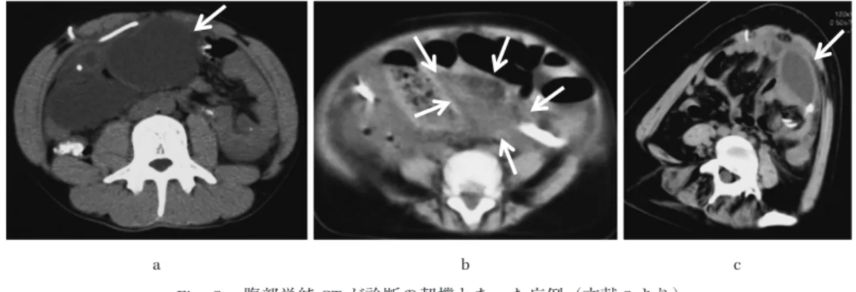 Fig. 5. 腹部単純 CT が診断の契機となった症例（文献 5 より） a）シャントチューブ先端周囲に嚢胞を認める（↓）。b）シャントチューブ周辺の腸管ガス像が消失し， 腸管の炎症が示唆される（↓で囲まれた部分）。c）シャントチューブ先端周囲に嚢胞を認める（↓）。abc バルブがあり，近位（頭側）から遠位（腹側）への一方 通行となっている。バルブ部分に，穿刺して髄液を採取 できるレザーバーが付属していることが多い。シャント 感染症の頻度は，報告により差が大きいが，近年の報告 の多くは 5〜10% 程度と