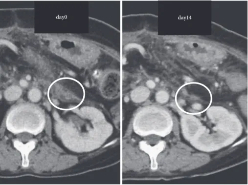Fig. 4. 腹部造影 CT 所見（左：血液培養陽性時（day0），右：治療開始 14 日後（day14））
