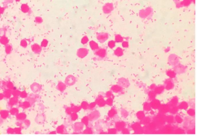 Fig. 1 Fig. 2. 腹部単純 CTabII． 質問と解答，解説Question 1：この患者に対する初期マネージメントを述べよ。解答1および解説：本例をまとめると，低アルブミン，耐糖能異常，ステロイド投与という易感染性を基礎にもつCHDF使用中の高齢男性で，抗菌薬使用歴（SBT!CPZ）があり，入院中に発症した腸管穿孔による二次性腹膜炎の症例である。感染症の基本的なアプローチとして，感染部位の特定，感染微生物の推定，感染巣コントロールや抗微生物薬投与などの治療を考える必要がある。また同時に，その感