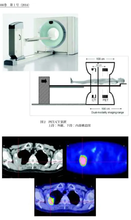 図 3 PET/CT で撮影された胸部画像（右肺がん症例）    左上段：CT 画像、右上段：PET 画像、下段：PET と CT の融合画像図 2 PET/CT 装置   上段：外観、下段：内部構造図  このように PET 検査は他の画像検査と異なり、い ろいろな特殊性を有している。  検査の費用は、10 万円弱であり、保険の 3 割負 担で 3 万円弱となる。他の画像検査と比べ高額であ るが、アメリカやドイツで FDG-PET を受けた場合、 約 20 万円になるそうである。あの物価の安い中国 でさえ、