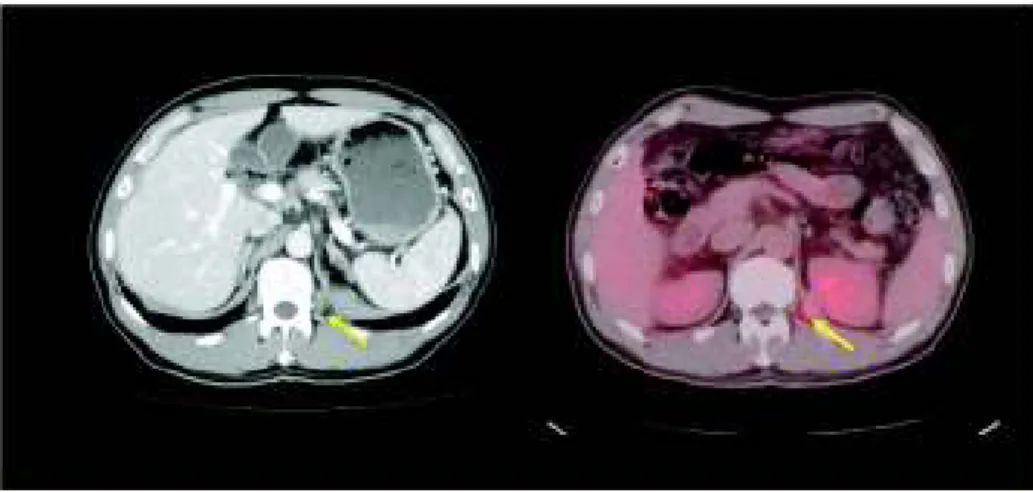 図 4 肺がん術後 5 年での再発例    左：造影 CT、右：PET/CT 画像    造影 CT 単独では指摘し得なかった左横隔膜への転移を FDG-PET/CT で指摘した（矢印） 。PET が有効ながんとそうでないがん 現在、保険診療として、「早期胃がんを除く全ての悪性腫瘍の診断に PET は利用可（ただし条件あり）」となっている。しかし、がんの種類によりブドウ糖利用状態が異なるため、FDG が有用ながんとそうでないものがあり、PET の利用状況にはがんの種類によって偏りが存在する。本邦での FDG