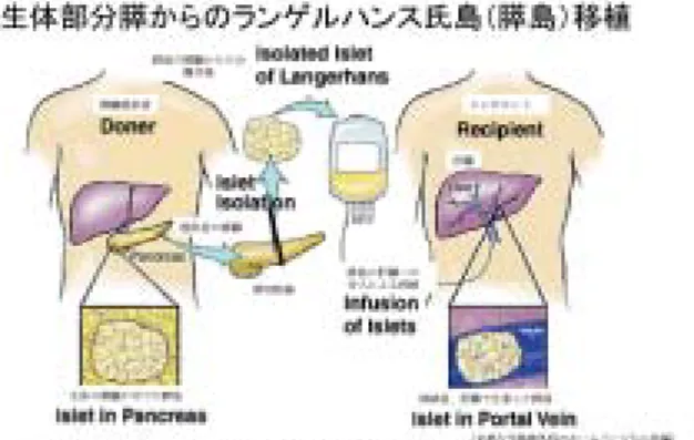 図 12：膵臓移植による糖尿病の完治 移植された膵臓が     正着した患者では、HbA1c 値が全例 5.8％以下と     血糖の正常化が可能である。めて大であります。 糖尿病の根治的治療法−バイオ細胞による膵移植  糖尿病の根治術として、機能の廃絶した膵臓をバイオ細胞で置換する方法があります。脳死患者の膵臓を移植する、臓器移植は外国の臓器移植以上の遠隔成績結果を得ていますが、移植可能な臓器数が少なく、極めて限られた１型糖尿病患者しかその恩恵に浴していないのが現状です（図 12） 。長期間正着し、発がん