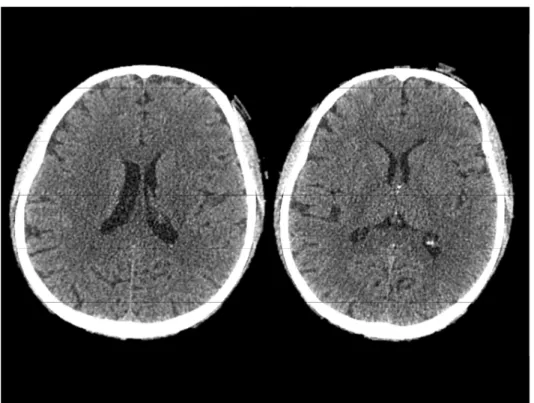 Fig. 2 Brain CT scan. High density area and early ischemic changes were absent.