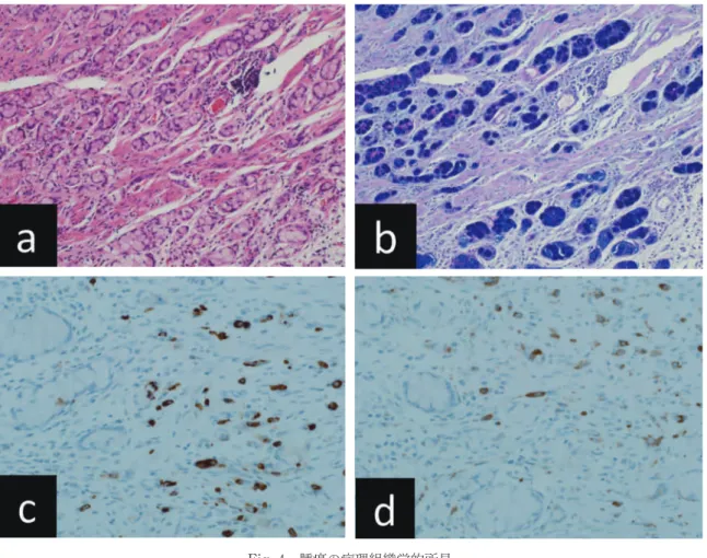 Fig. 5 白色結節部分の病理組織学的所見 白色結節部分は粘液が石灰化したものであり，腫瘍 細胞は認められなかった（矢印，H.E.染色，1.25倍）。