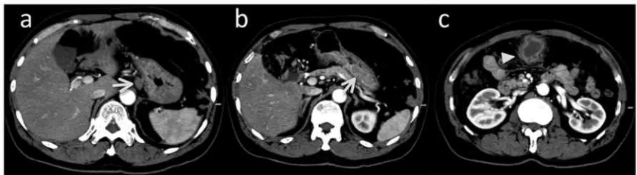 Fig. 1   Abdominal CT showed swelling lymph nodes (a ;arrow)and the thickened wall(b ;arrow)at the stomach.