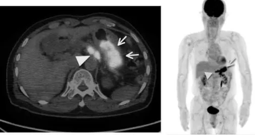 Fig. 5   Upper gastrointestinal endoscopy showed a polypoid  lesion  as  previous  examination. 