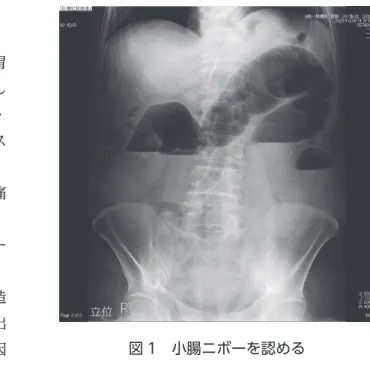 図 1　小腸ニボーを認める