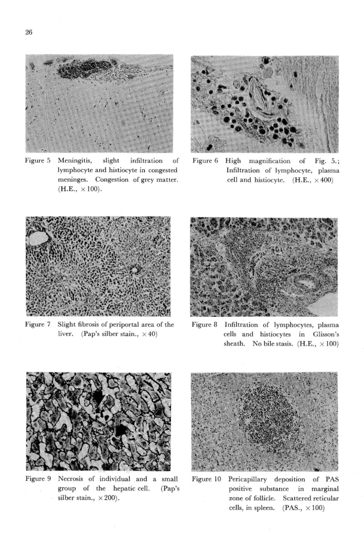Figure 5  "": '̲' : '1*"";' * * ="::'='i ='i' t!:' *   Meningitis, slight infiltration of Figure 6  lymphocyte and histiocyte in congested  meninges. Congeation ofgrey matter,  (H.E., x 100).  High magnification oi'  Infiltration of lym