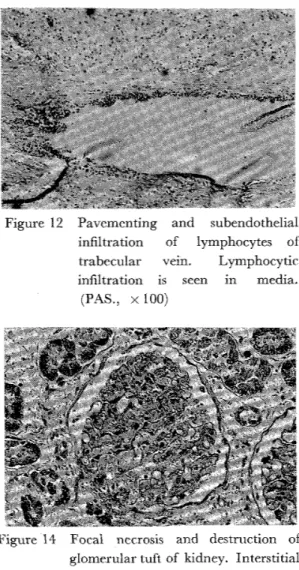Figure 1 3 subendothehal infiltration of kylTIPho‑