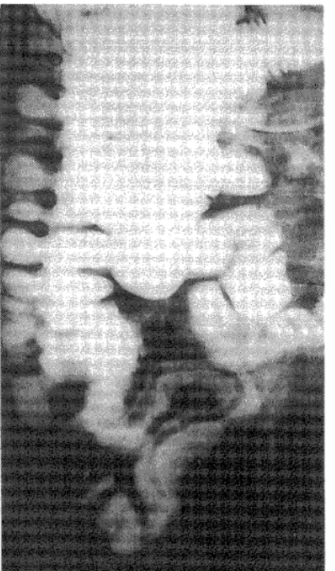 Figure 1  T. saginata  shado r  in  case 4) is clearly seen as a radiolucent  the iieo‑coecai segment.  Figure Z  D. latum.  segment .  (c Se 5)  is ebserved in the ileo‑coecal 