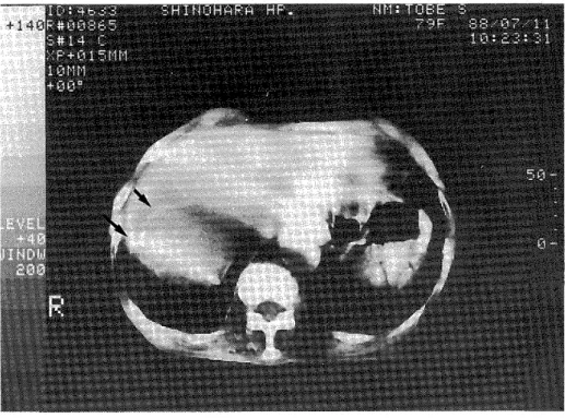 Figure 5 High density funicular patterns by CT examination is  shown in the photograph. Septal calcification  (indicated by arrows) in the edge of the liver is  sus pected.  Figure 6 (A)  Plain CT picture of the brain of the patient. Arrow  indicates local