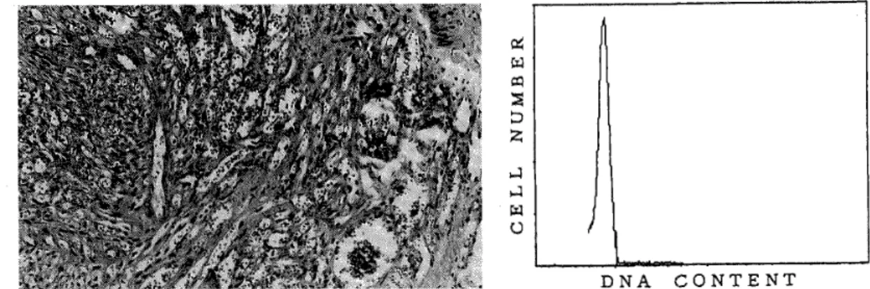 Figure 2  e  ,     ; ･i l O   (left) Case 6(angioma/angiosarcomalike  composed predominantly of anastomosing  well‑formed vessels (H.E., x 100) ,  diploidy (CV 7.7) .  DNA CONTENT type). The lesion is vascular channels and (right) DNA histogram showing  Fi
